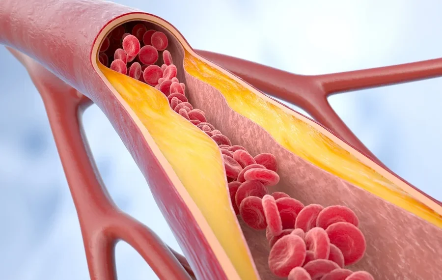Por que reduzir o colesterol LDL é decisivo para proteger o coração