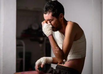 Orelha derretida e mão atrofiada: trabalhador atacado e queimado na rua relembra pesadelo