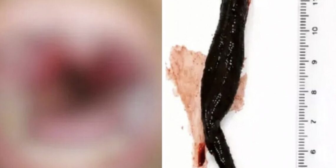 Sanguessuga viva fica alojada na garganta de menina após ela beber água de riacho
