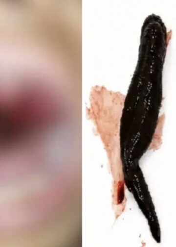 Sanguessuga viva fica alojada na garganta de menina após ela beber água de riacho